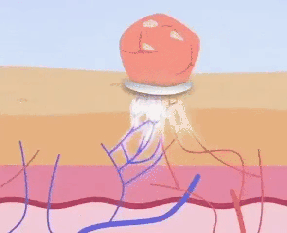 Schmerzloser Hautanhängsel Entferner