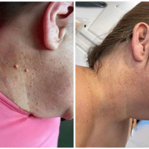 Hautanhängsel Entferner Bestseller