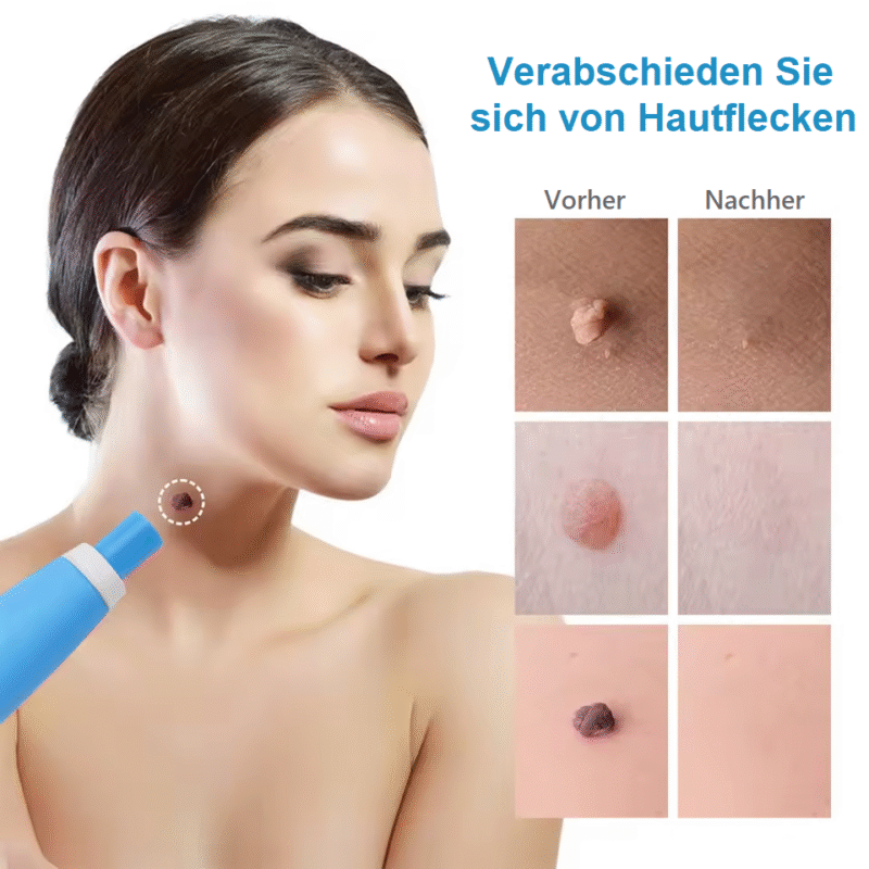 Muttermal entfernen ohne OP
